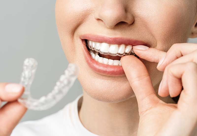 Paciente encaixando o alinhador transparente nos dentes enquanto segura o alinhador seguinte