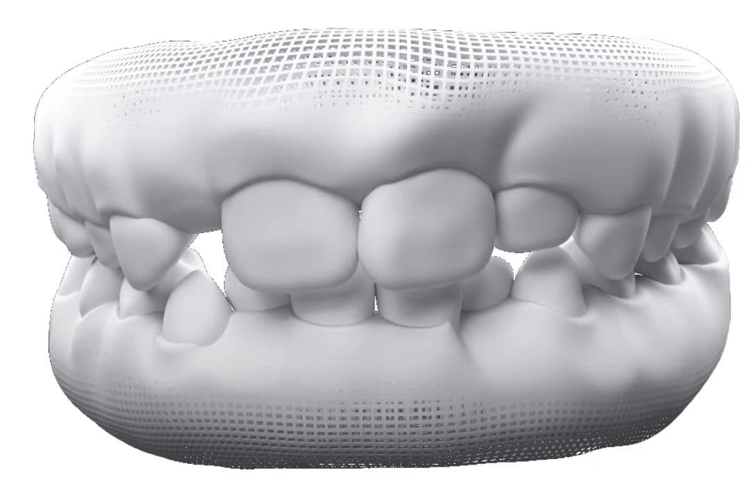Arcada dentária ilustrando o caso de dentição mista